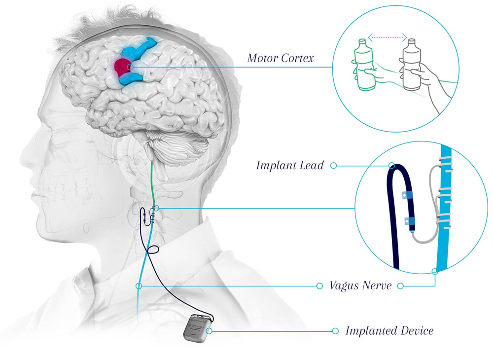 Illustration of human brain showing motor cortex, which aligns with a drawing of a hand moving a water bottle; the implant lead and vagus nerve, which are attached; and the implanted device, which is a small square shown near the shoulder.