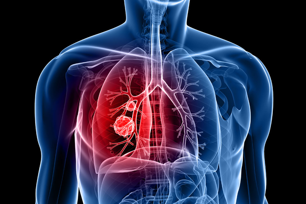 Scientists’ Engineered Protein Slows Lung Cancer Growth